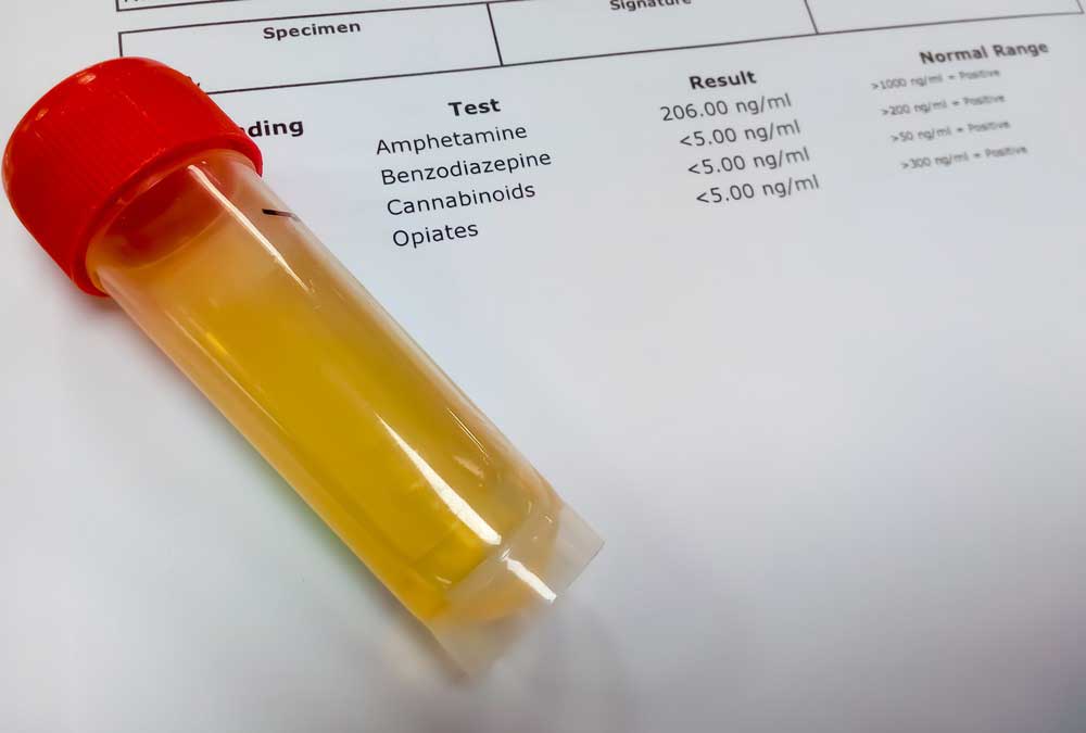 Preparing For a Urinalysis